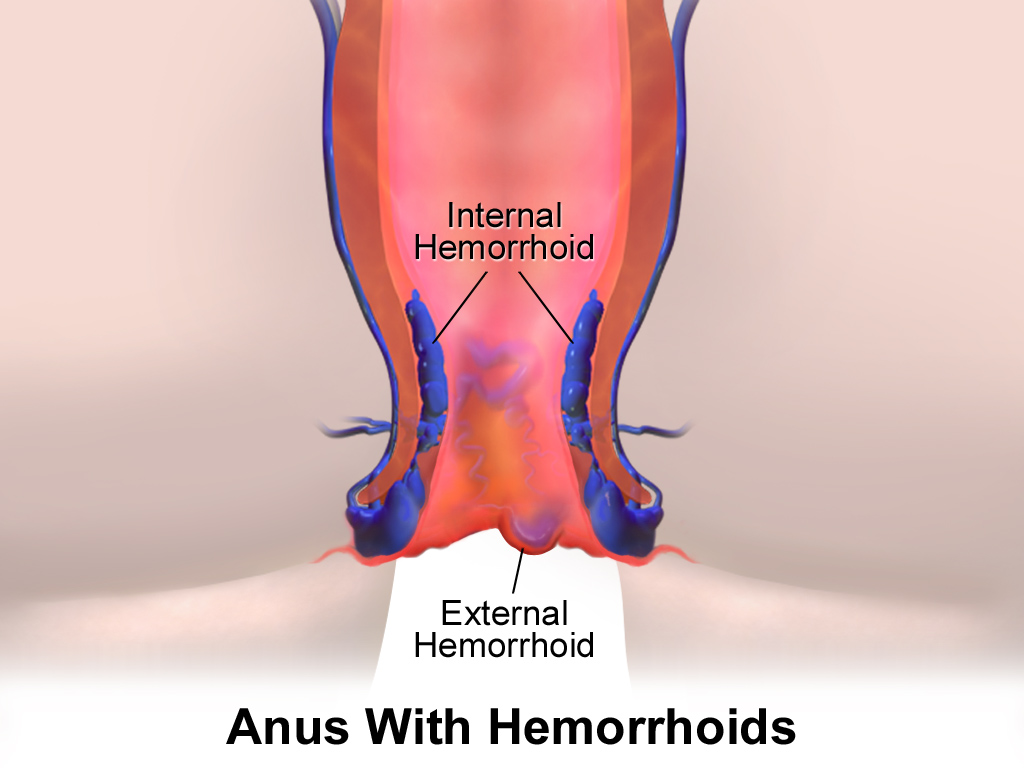 hemorrhoids